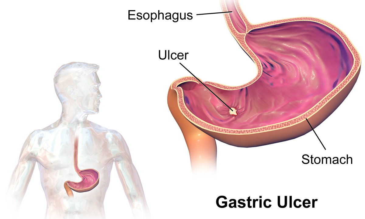 Post-gastrectomy complications