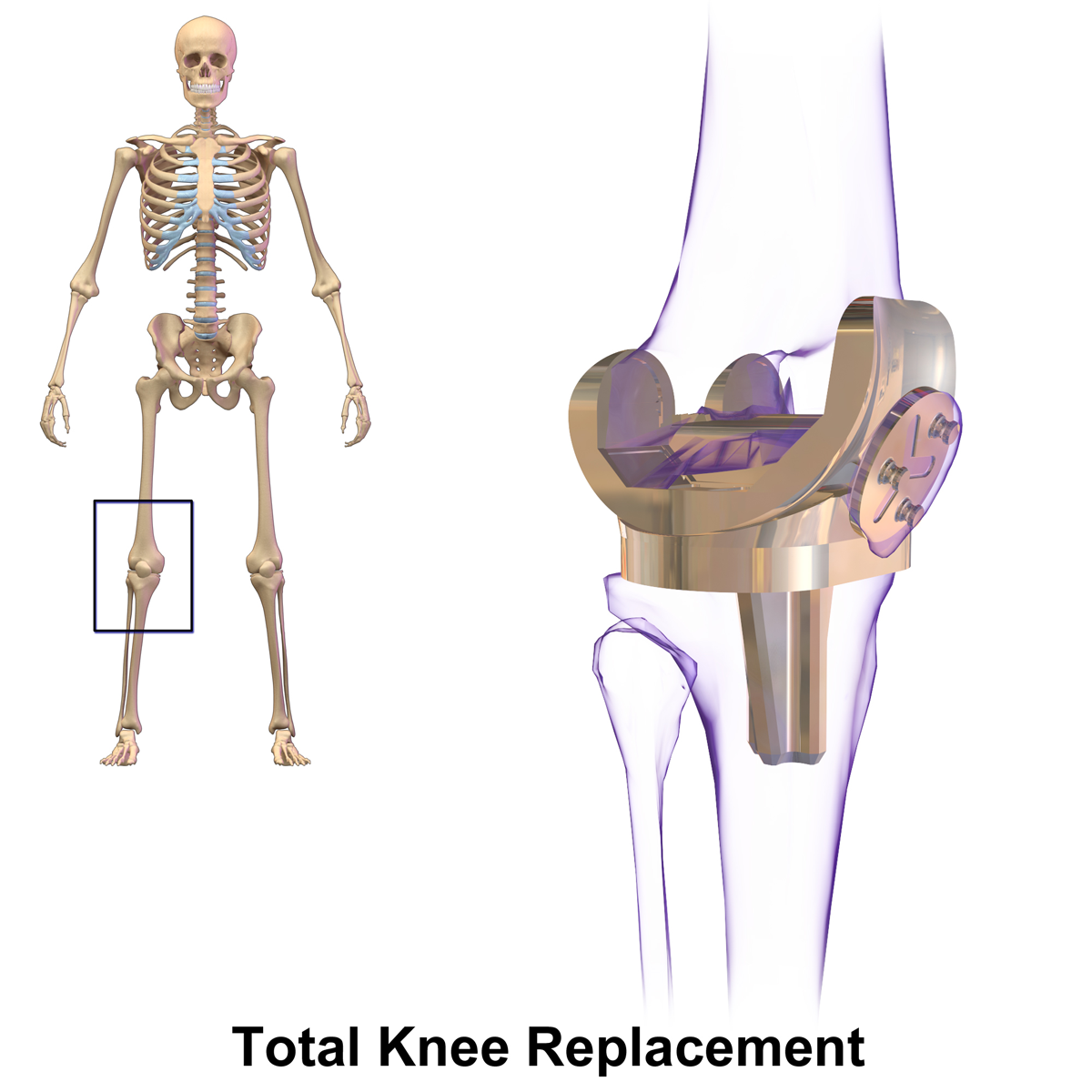 A medical illustration of a total knee replacement, a skeleton at left with the knee boxed and a rendered titanium implant enlarged at right, 2015